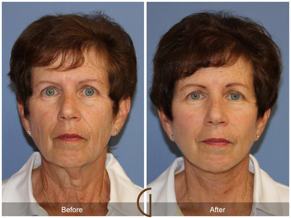 Before and after gallery for Orange County, Newport Beach facial plastic surgeon Dr. Kevin Sadati