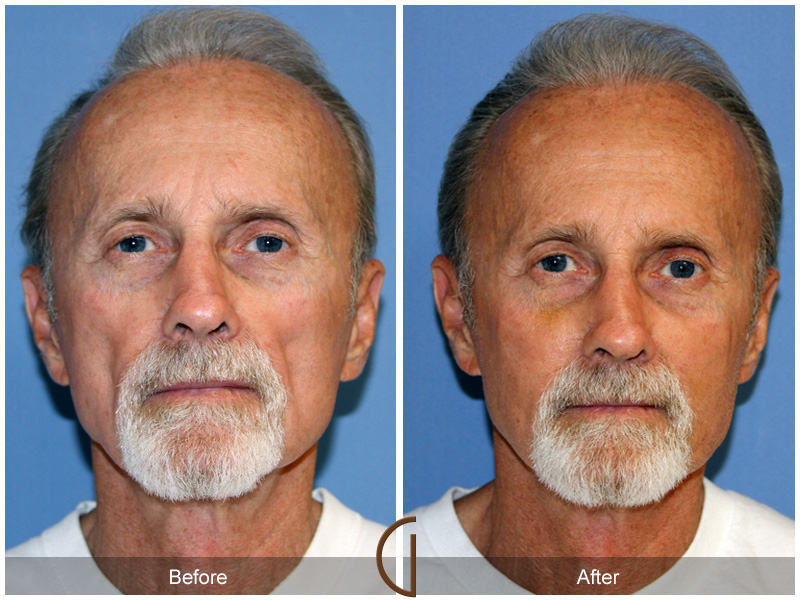 Before and after gallery for fat-grafting patient 07