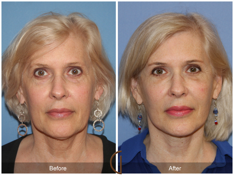 Before and after gallery for Orange County, Newport Beach facial plastic surgeon Dr. Kevin Sadati