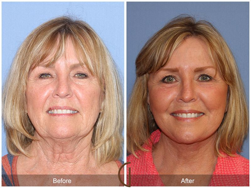 Before and after gallery for Orange County, Newport Beach facial plastic surgeon Dr. Kevin Sadati