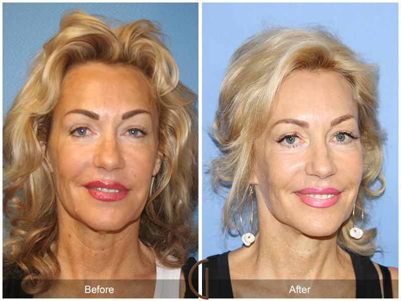 Before and after gallery for Orange County, Newport Beach facial plastic surgeon Dr. Kevin Sadati