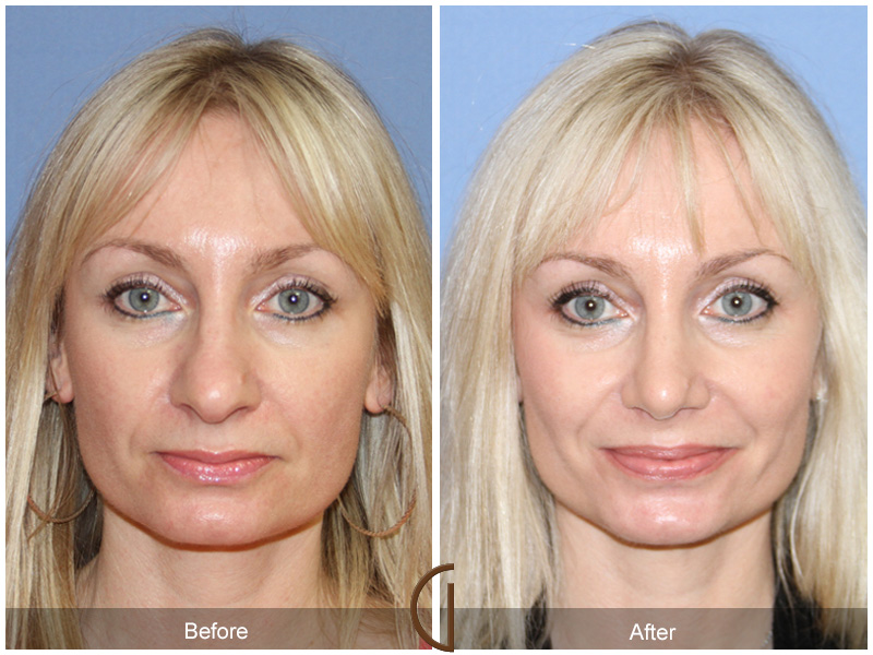 Before and after gallery for Orange County, Newport Beach facial plastic surgeon Dr. Kevin Sadati