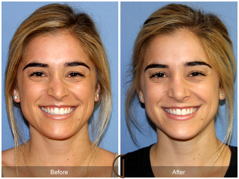 Before and after gallery for Orange County, Newport Beach facial plastic surgeon Dr. Kevin Sadati