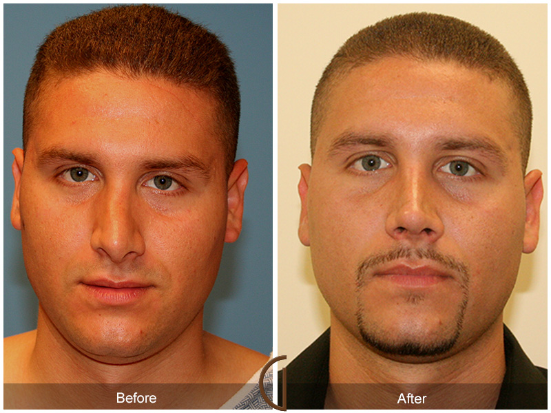 Before and after gallery for Orange County, Newport Beach facial plastic surgeon Dr. Kevin Sadati