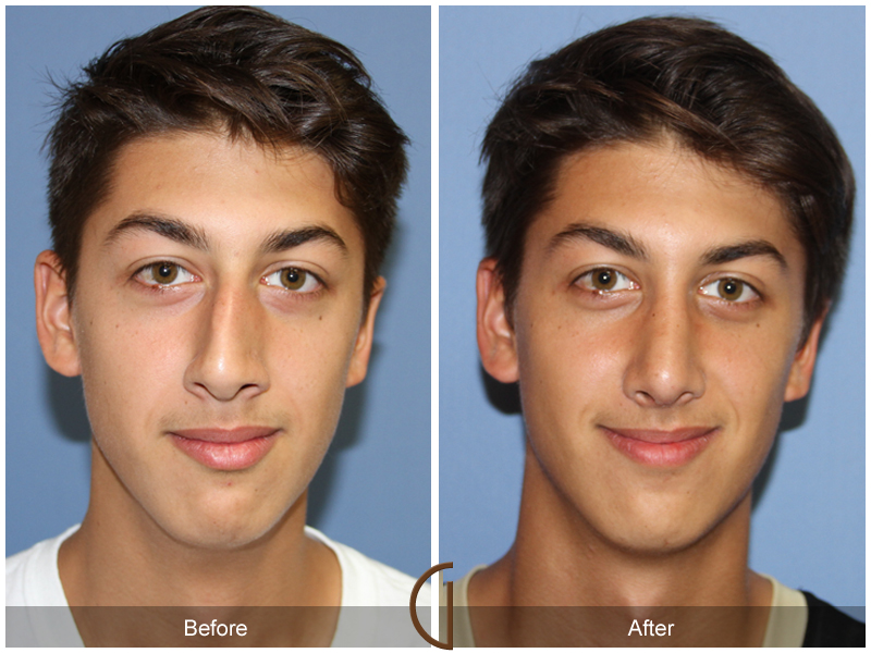 Before and after gallery for Orange County, Newport Beach facial plastic surgeon Dr. Kevin Sadati