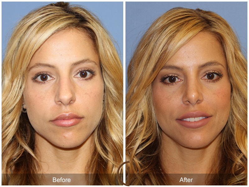 Before and after gallery for Orange County, Newport Beach facial plastic surgeon Dr. Kevin Sadati